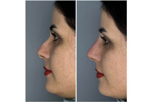 مزایای فرم دهی بینی با فیلر 