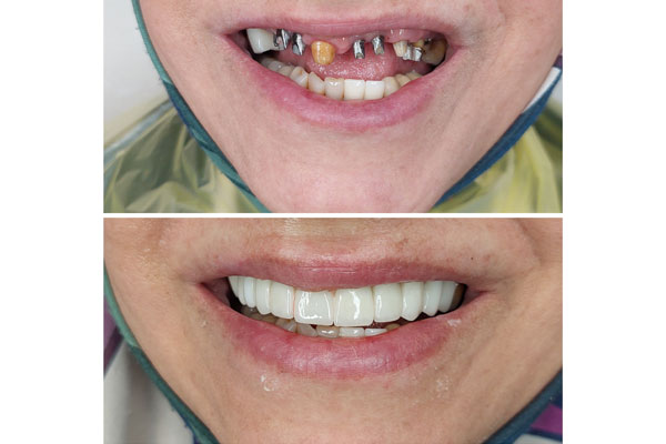 روکش دندان توسط دکتر کوروش صادقی