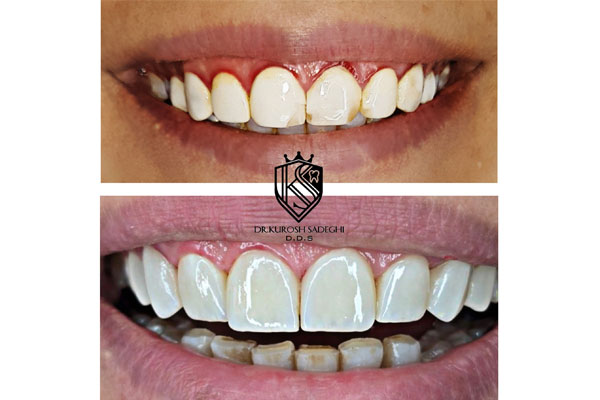 انواع روش های زیبایی دندان