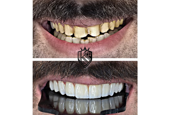 با انواع روش‌های زیبایی دندان آشنا شوید