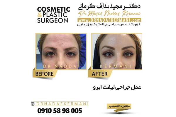 دکتر مجید نداف کرمانی - لیفت شقیقه