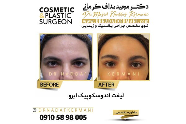 انواع روش های غیر جراحی لیفت ابرو کدامند؟