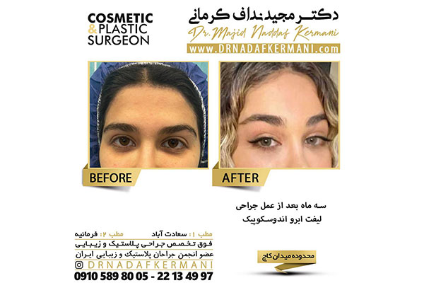 دکتر مجید نداف کرمانی - لیفت شقیقه