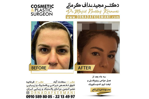 نکات مهم قبل از اقدام به لیفت شقیقه