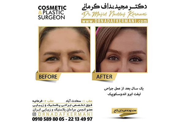 کدام یک برای لیفت ابرو بهتر است