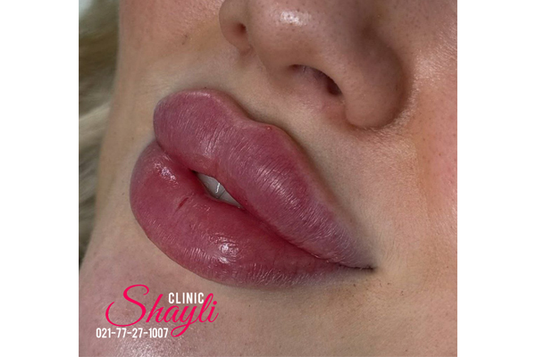 تکنیک‌های صحیح تزریق و کاهش عوارض