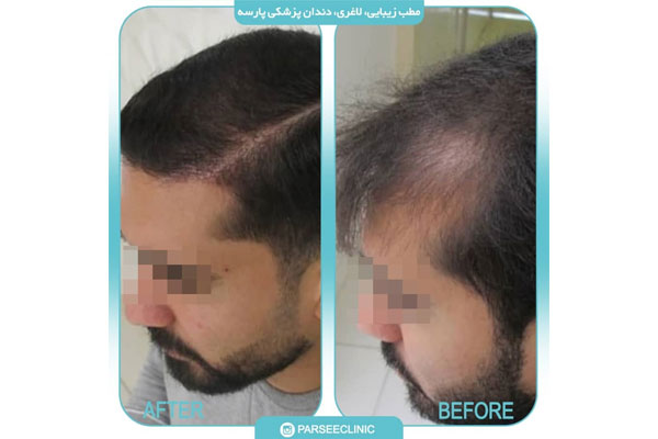 انجام پی آر پی توسط دکتر معصومی