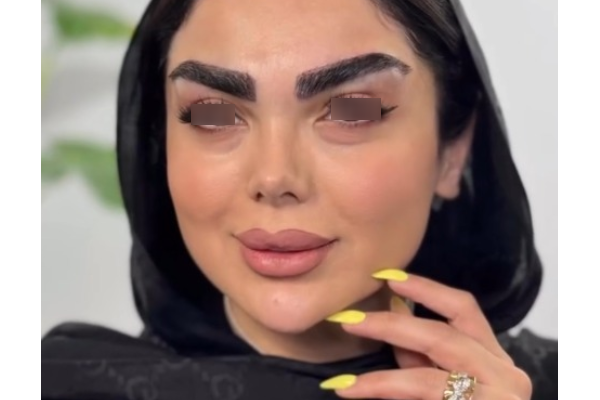 کاشت تخصصی ابرو با خواب طبیعی