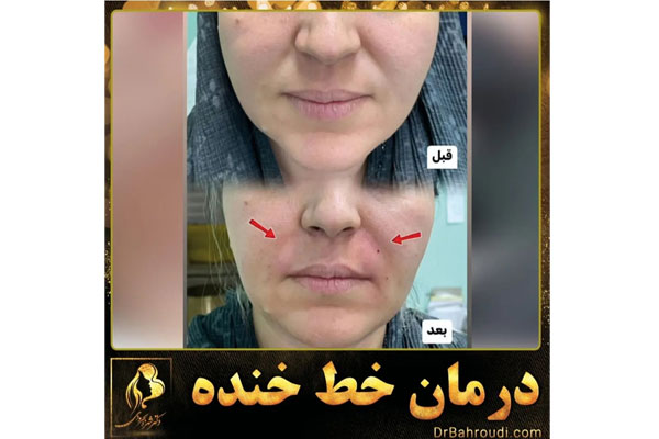 خطرات تزریق فیلر در بارداری 