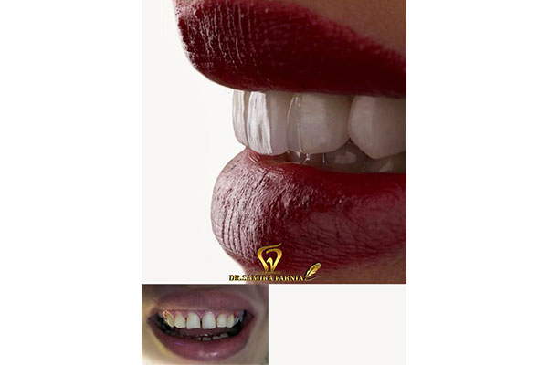 آمادگی های لازم قبل از لمینت دندان