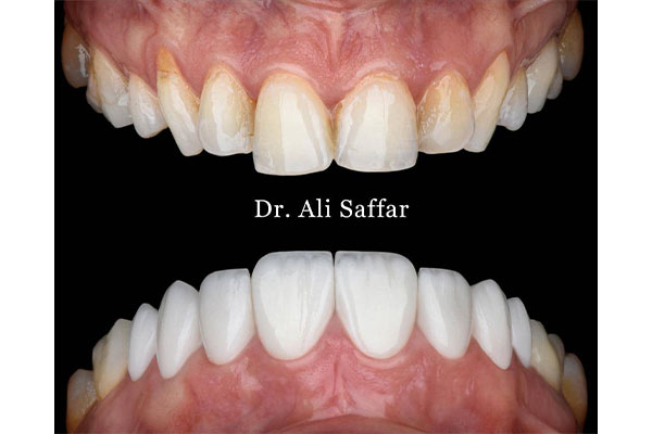 دندانپزشکی دکتر علی صفار - ایمپلنت دیجیتال