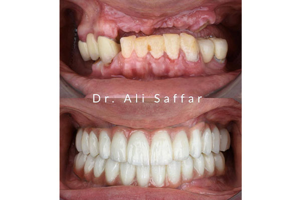 دندانپزشکی دکتر علی صفار - ایمپلنت دیجیتال