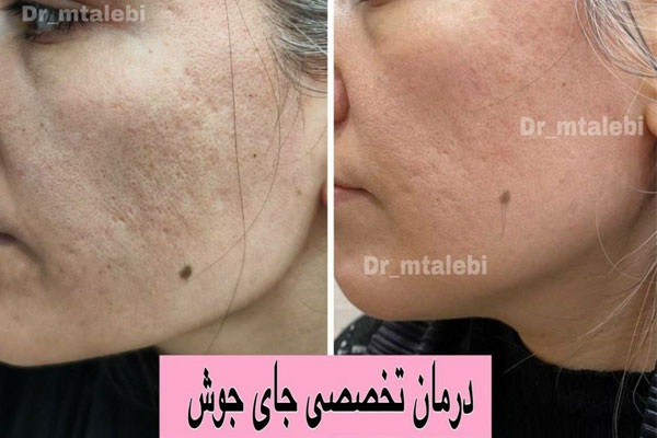 چرا اسکار و جای جوش ایجاد می‌شود؟