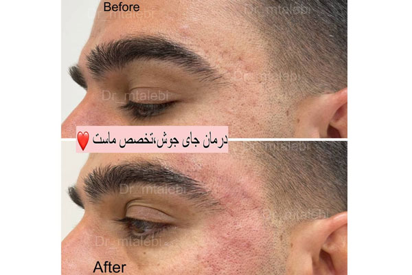 روش‌های درمان اسکار و جای جوش فرورفته