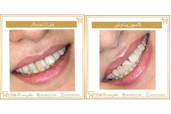 طول عمر کامپوزیت دندان چقدر است؟