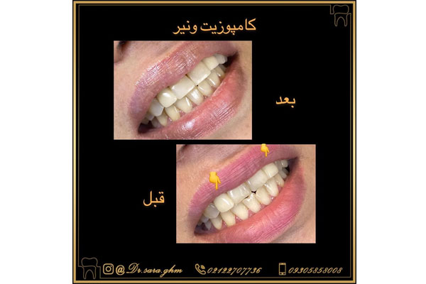 چه مواردی بر دوام کامپوزیت دندان موثرند؟