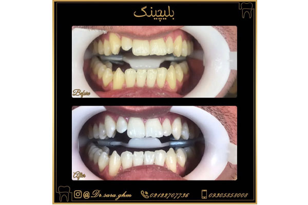 مراحل انجام بلیچینگ دندان