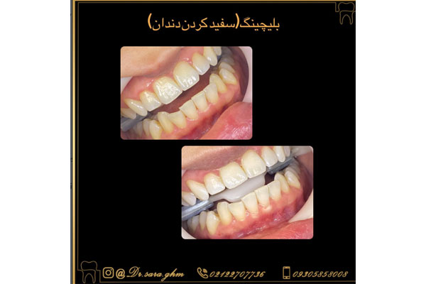 چرا دکتر سارا قائم مقامی انتخاب مناسبی برای بلیچینگ دندان است؟