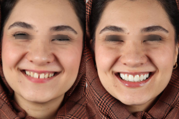 نقش مهارت دندانپزشک در کیفیت کامپوزیت