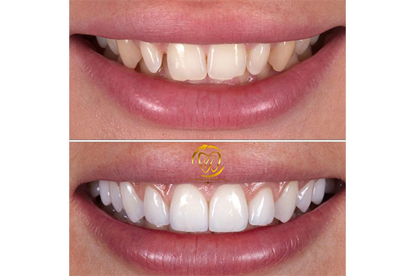 انواع کامپوزیت دندان