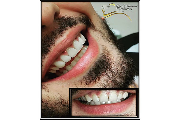 مزایا و معایب کامپوزیت میکروفیل