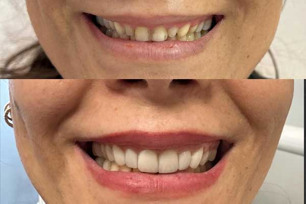 طراحی لبخند شامل چه خدماتی میباشد؟