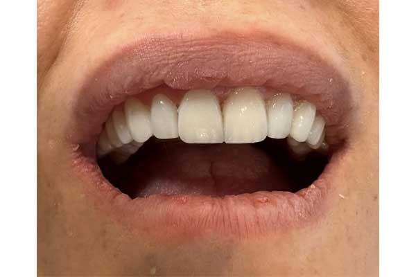 مراحل انجام طراحی لبخند به چه صورت است؟