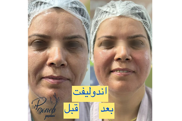 اندولیفت صورت سریع انجام می‌شود؟ مدت لیفت و ماندگاری