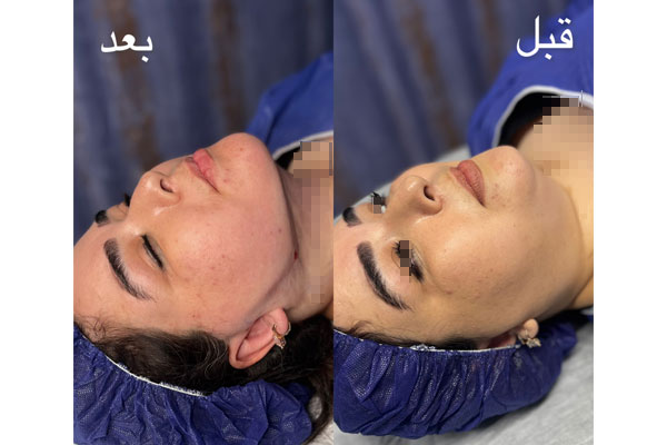 مزایای ساکشن غبغب