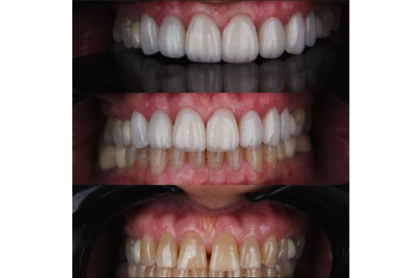 مزایای پرکردگی کامپوزیتی