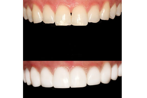 انواع روش‌های ترمیم دندان