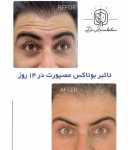 تزریق بوتاکس آپرفیس - دکتر زرین بادینی مرکز زیبایی پوست و مو