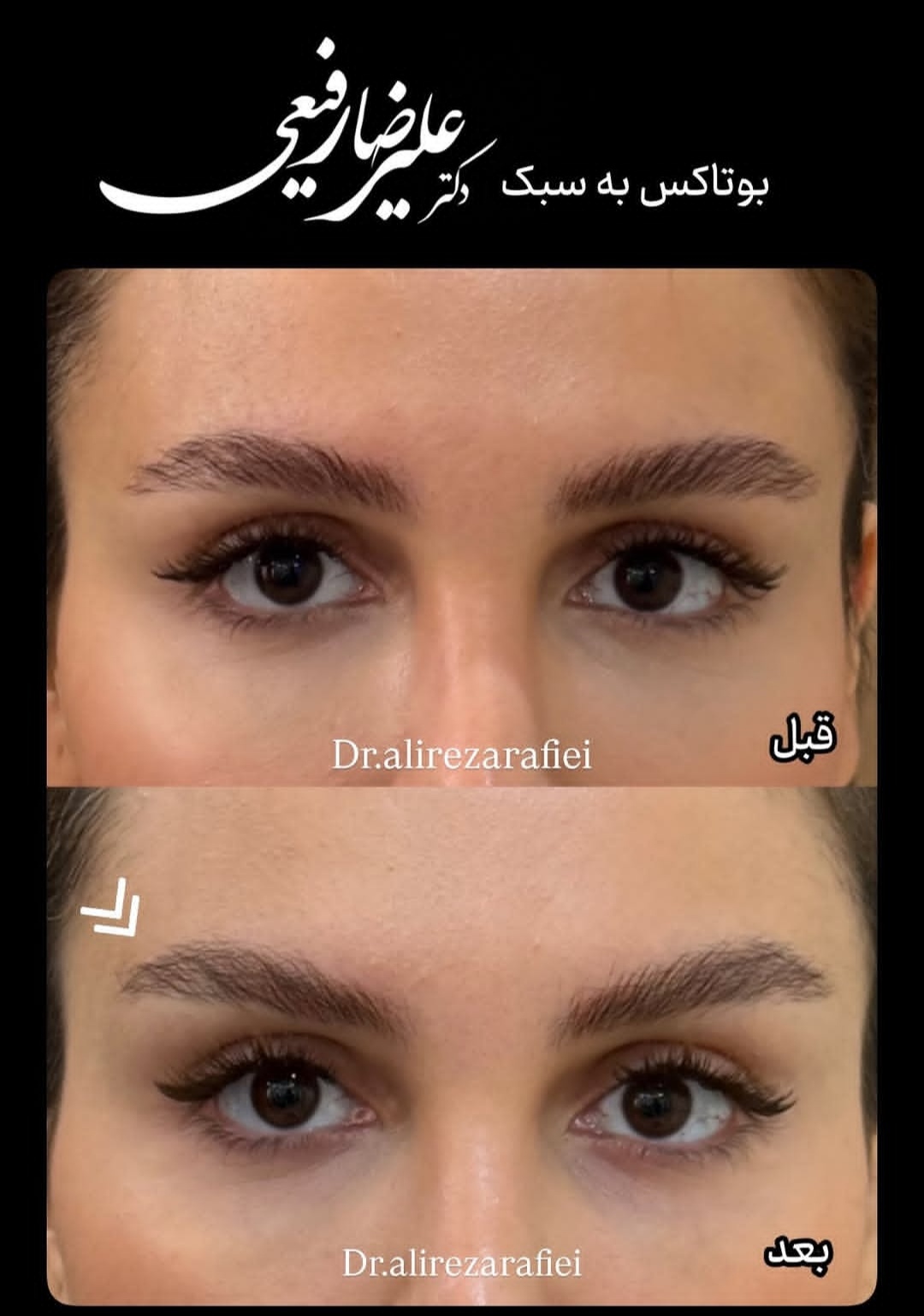 تصویر بوتاکس چشم گربه ای به سبک دکتر رفیعی