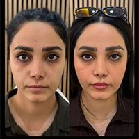 جوانساز نسل چهارم: PLLA و PDLLA توسط دکتر علیرضا رفیعی