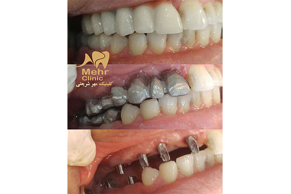 تصویر ایمپلنت دندان - کلینیک دندانپزشکی مهر شریعتی
