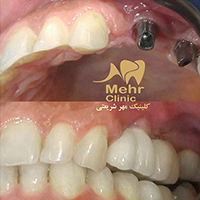 ایمپلنت دندان - کلینیک دندانپزشکی مهر شریعتی