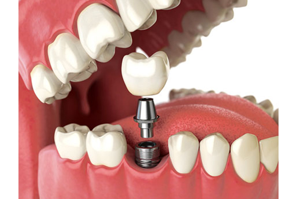 تصویر ایمپلنت اقساطی کره ای - کلینیک دندانپزشکی مهر شریعتی