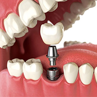 ایمپلنت اقساطی کره ای - کلینیک دندانپزشکی مهر شریعتی