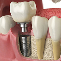 ایمپلمنت مگاژن/ دنتیون - کلینیک دندانپزشکی مهر شریعتی