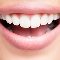 ونیر کامپوزیت سایکو - کلینیک دندانپزشکی مهر شریعتی