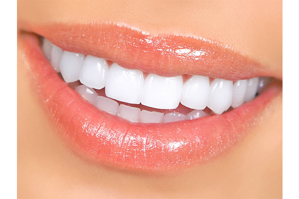 تصویر ونیر کامپوزیت ips -  کلینیک دندانپزشکی مهر شریعتی