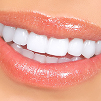 ونیر کامپوزیت ips -  کلینیک دندانپزشکی مهر شریعتی