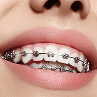 ارتودنسی - کلینیک دندانپزشکی مهر شریعتی