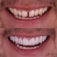 ونیر کامپوزیت - کلینیک دندانپزشکی راحیل