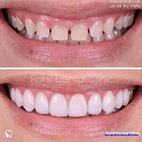 لمینیت دندان - کلینیک دندانپزشکی راحیل