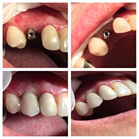 ایمپلنت دندان - کلینیک دندانپزشکی راحیل