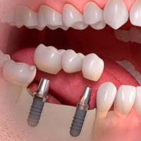ایمپلنت آمریکایی دندان - دکتر کیهان قدیمی