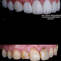 لمینیت دندان - مرکز دندانپزشکی دیجیتال دکتر زهرا حجت خواه