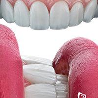 کامپوزیت دندان - مرکز دندانپزشکی دیجیتال دکتر زهرا حجت خواه