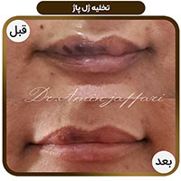 تخلیه ژل معیوب - دکتر امین جعفری